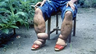 Lymphatic Filariasis Elephantiasis [upl. by Jarrell]