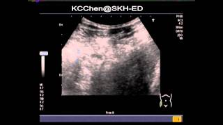 Cecal diverticulitis [upl. by Khosrow]