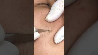 Best Pimple Popping 13 reels beautiful blackheads sacdepspa cute health [upl. by Enilrek]