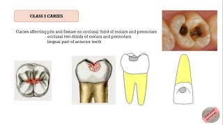 Quick Revision of G V Blacks Classification of Dental Caries [upl. by Aivun959]