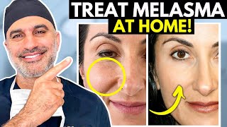 What you NEED to know about treating Melasma AT HOME the RIGHT way [upl. by Glavin226]