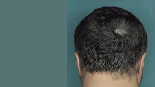 Drug Restores Hair Growth in Patients with Alopecia Areata [upl. by Scrivenor733]