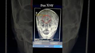 x ray pns  frontal sinus  radiology  youtubeshorts youtube viralvideo shorts radiology [upl. by Idram]