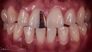 Diastema closure with Gold onlay and composite resin [upl. by Sasnak]