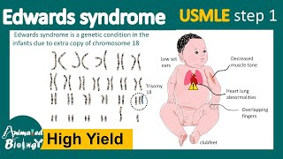 Edwards Syndrome A Deep Dive into Recent Research [upl. by Sheryl]