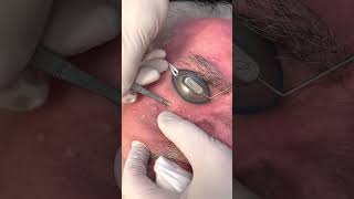 Smooth Beam Laser for the treatment of Sebaceous Hyperplasia [upl. by Holmun760]