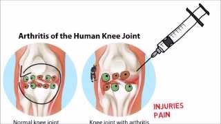 What is stem cell therapy Orthobiologics [upl. by Ahseikan]