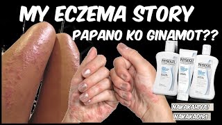 PAANO GAMOTIN ANG ECZEMA SUGAT SUGAT NA KAMAY 1 WEEK LANG [upl. by Idnal]