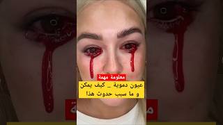 لماذا توجد أعين دموية  لا داعي للذعر إذا رأيت عينا دموية [upl. by Emiatej]