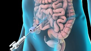 Laparoscopic Lysis of Abdominal Adhesions 2011 [upl. by Jochebed]