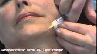 Viscoderm 16 30 Gneedle Dr Salti [upl. by Waverley54]