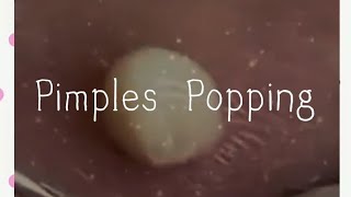 Pimples amp Blackheads Popping  59 [upl. by Bury]