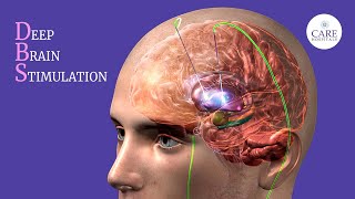 Deep Brain Stimulation Surgery Explained  How is DBS surgery done [upl. by Lupee644]