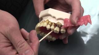 What is Periodontal Disease [upl. by Purvis]