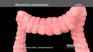 Irritable Bowel Syndrome IBS [upl. by Royo]