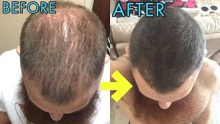 CRAZY MICRONEEDLING BEFOREAFTER RESULTS FOR HAIR REGROWTH [upl. by Karame]