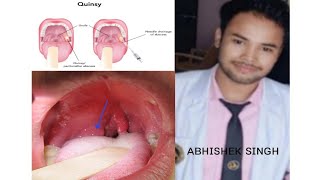 Quinsy Acute tonsillar infection के बारे में समझें।wait for end quinsy tonsillitis [upl. by Rothschild]