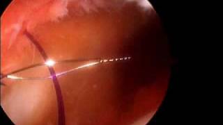 Arthroscopic Medial patella plication Dr A Reznik [upl. by Barbur]