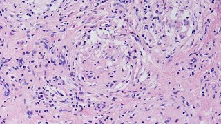 A Case of Granulomatous Orchitis  Pathology mini tutorial [upl. by Heady]