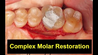 Misdiagnosed Molar Case [upl. by Penrod]