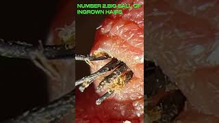 top 5 ingrown hair Super Fast [upl. by Odnomyar]