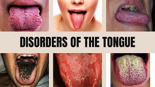 Tongue Diseases Geographic Tongue Black Hairy Tongue Glossitis Thrush and Leukoplakia [upl. by Deth]