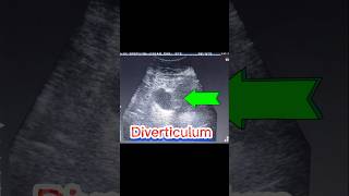 DIVERTICULA BLADDER  U bladder Stone  Cystitis  Residual Urine PMRV ultrasound [upl. by Darce]