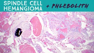 Spindle cell hemangioma with phlebolith arising in a vascular malformation pathology dermpath [upl. by Ruzich906]