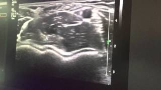 Demo echografie elleboog Biceps Arterie Medianus BAM [upl. by Ah]