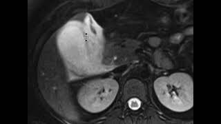 Acute Cholecystitis [upl. by Gemmell]