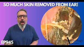 SO MUCH SKIN REMOVED FROM PATIENTS EAR CANAL  EP945 [upl. by Kazmirci]