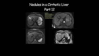 Nodules in a Cirrhotic Liver  Part 12 radiology radiologist cirrhosis liverdisease liverhealth [upl. by Elleved452]