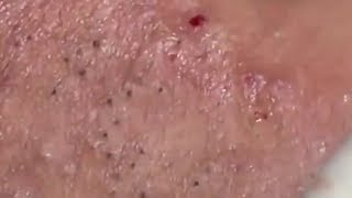 How To Remove Blackheads And Whiteheads On Face Easy 102 ✦ Dr Laelia ✦ [upl. by Enneibaf702]