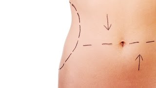 Tummy Tuck vs Liposuction  Plastic Surgery [upl. by Idette]