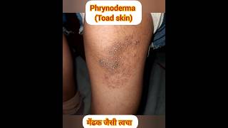 PHRYNODERMA मेंढक जैसी त्वचा malnutrition dryskin skincare pigmentation shortsfeed shorts [upl. by Ecenaj]