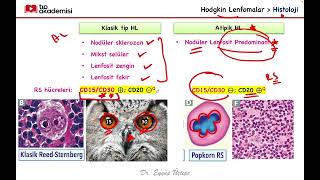 Hematolojik Malignitelerin Sınıflandırılması ve Hodgkin Lenfoma [upl. by Assanav]