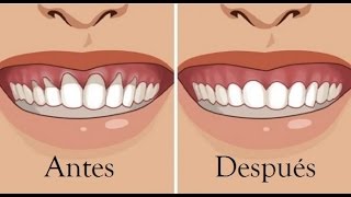 Retracción de encías remedios caseros para arreglarlas [upl. by Eirrod]
