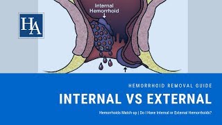 Internal Versus External Hemorrhoids Matchup  Do I Have Internal or External Hemorrhoids [upl. by Amlez]