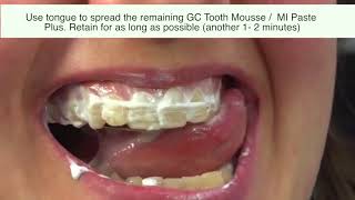 2 Methods to Use GC Tooth Mousse I Tooth Mousse Plus I MI Paste [upl. by Hanshaw]