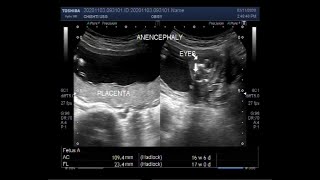 Ultrasound Video showing Anencephaly with a pregnancy of about 17 weeks [upl. by Ynad812]