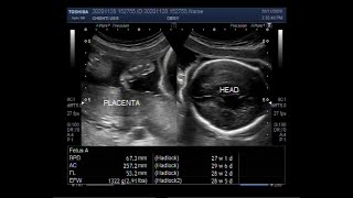 Ultrasound Video showing late stillbirth with a pregnancy of more than 28 completed pregnancy weeks [upl. by Ahon]