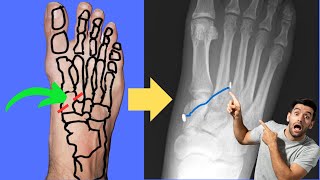 Lisfranc Injury Can it be fixed with an ANKLE TIGHTROPE [upl. by Judi250]