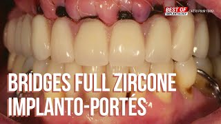 Les bridges full zircone implantoportés  Implantsupported full zirconia bridges [upl. by Nnylrebma729]