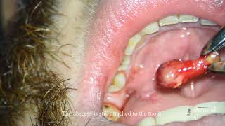 Dental abscess still attached to an infected tooth [upl. by Granger]