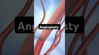 Angioplasty and Stent placement surgery surgery medical animation [upl. by Adlar116]