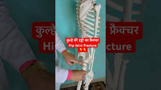 कुल्हे की हड्डी का फ्रैक्चर  Hip Joint Fracture  Femur Bone shorts viral youtubeshorts [upl. by Asehr]