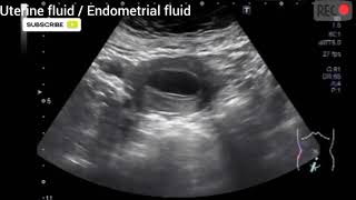 Uterine fluid I Endometrial fluid I Minimal fluid collection in uterine cavity [upl. by Ahsinam823]