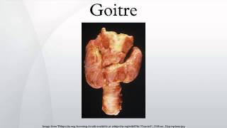 Goitre [upl. by Booth]