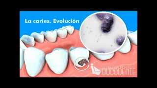 Bucodente Evolución de la caries [upl. by Marion658]