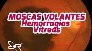 Moscas Volantes Causas e sintomas Parte 4 Hemorragias Vítreas [upl. by Kudva]